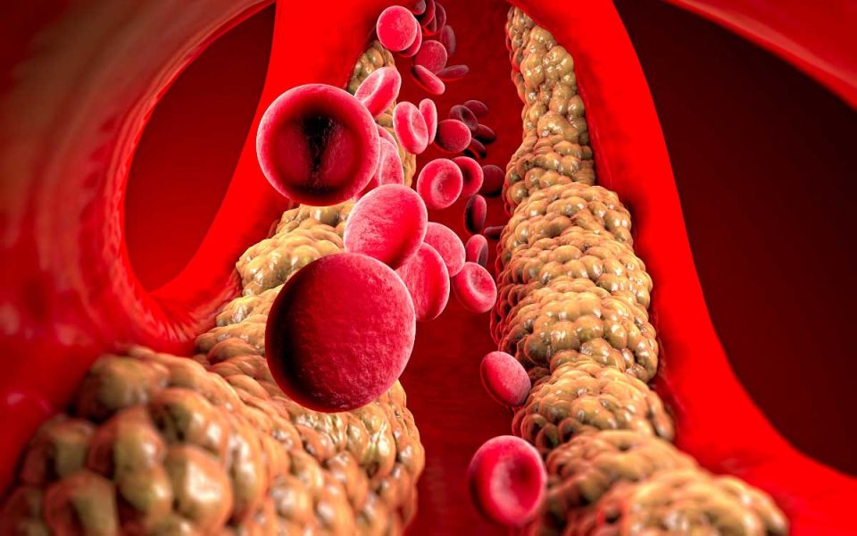 Understanding and Managing High Triglycerides