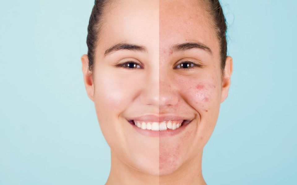 Two Docs Talk: Acne