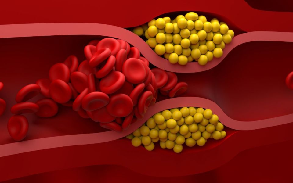Is the Deadliest Condition Preventable? Understanding ASCVD and LDL-C