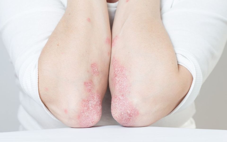 Psoriasis and the Immune System: More Confusing Than Teenage Slang
