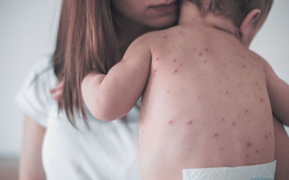 Why Measles Has Gone From Eradicated To Outbreak