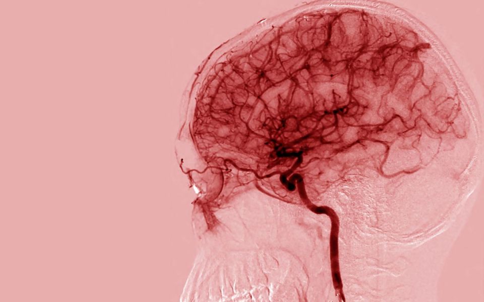 Vascular Dementia: Causes, Symptoms, Risk Factors, and Treatment Options