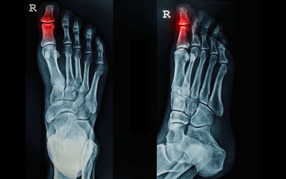 What is Gout and How is it Treated?