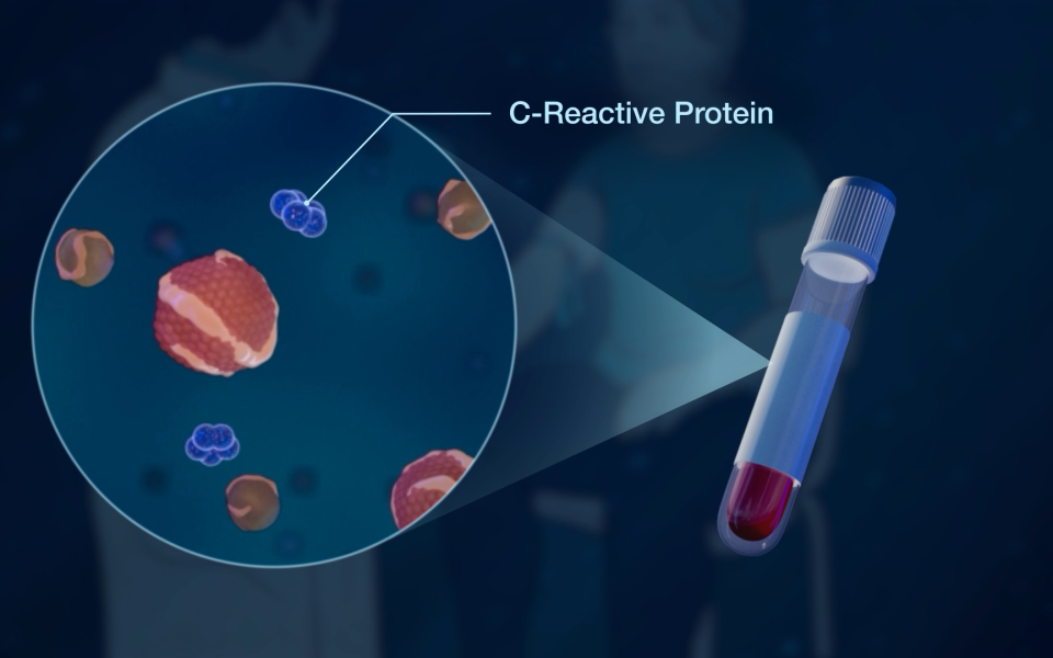 C-reactive protein: An Inflammation Marker