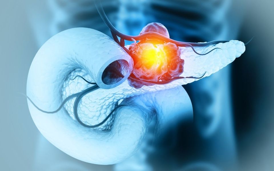 Early Detection Will Build The Foundation of Pancreatic Cancer Care